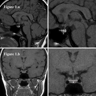 Small pituitary volume and central nervous system anomalies in Fanconi Anemia